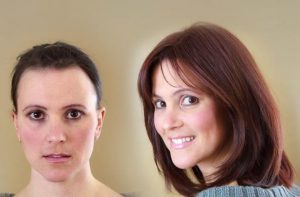 Before and After: Woman's Hair Loss