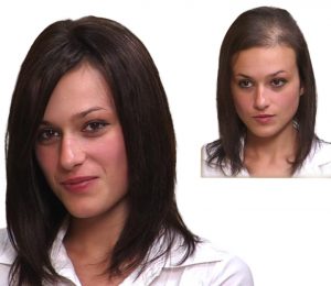 Woman Before and After Hair Replacement Procedure
