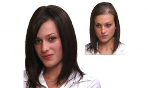 Woman Before and After Hair Replacement Procedure
