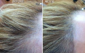 Woman Before and After Hairline Rescue Procedure