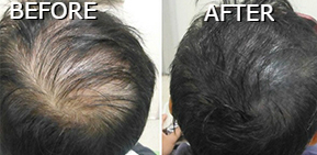 ​Male Before and After Hair Replacement Procedure