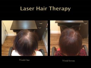 Before and After Laser Hair Therapy