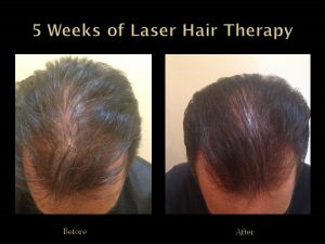 Progress from 5 Weeks of Laser Hair Therapy