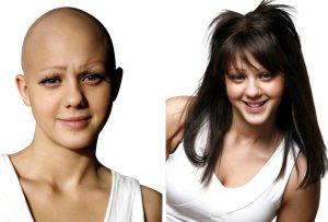 Woman With and WIthout Wig for Hair Replacement